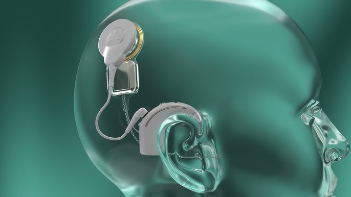 Ein grünlicher künstlich gestalteter Kopf mit Cochleaimplantat